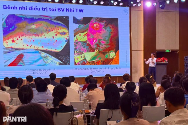 Thủy đậu không “lành tính”, gây nhiều biến chứng nghiêm trọng